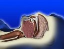 Sindrome delle apnee ostruttive del sonno