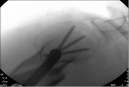 Proiezione assiale di omero. Proposta di una nuova proiezione radiografica intra-operatoria durante il posizionamento del chiodo endo-midollare nel trattamento delle fratture prossimali di omero
