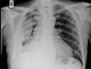Fattori prognostici nel mesotelioma pleurico maligno