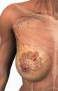 Chirurgia oncoplastica: nuovi paradigmi nel carcinoma della mammella