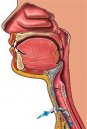 Angioedema indotto da farmaci: 