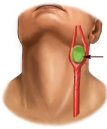 Paraganglioma carotideo: una diagnosi precoce