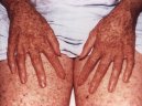 Xeroderma pigmentoso: i figli delle stelle. Caso clinico e revisione della letteratura.