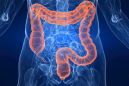 Resezione loco-regionale endoluminale con tecnica TEM versus Total Mesorectal Excision per via laparoscopica nel trattamento del cancro del retto T2 dopo terapia neoadiuvante